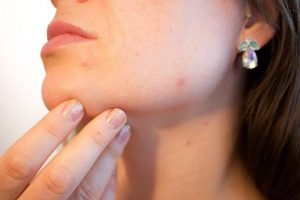 Natural Kozmetika for Acne: Your Clear-Skin Guide