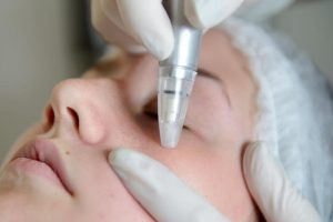 How Microdermabrasion Works at Professional Kozmetika